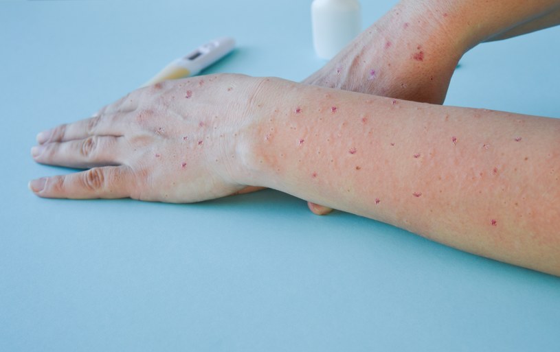 Objawy małpiej ospy i możliwość dotarcia wirusa Mpox do Polski - najnowsze informacje